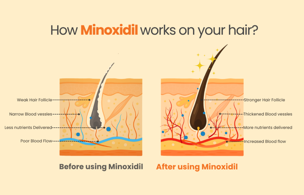 How Minoxidil works to regrow hair – visual comparison of hair follicles before and after Minoxidil treatment. Shows improved blood flow, thickened blood vessels, and stronger follicles. Effective hair fall treatment and baldness solution for men. Affordable Jan Aushadhi Minoxidil hair oil and hair fall spray for hair regrowth.